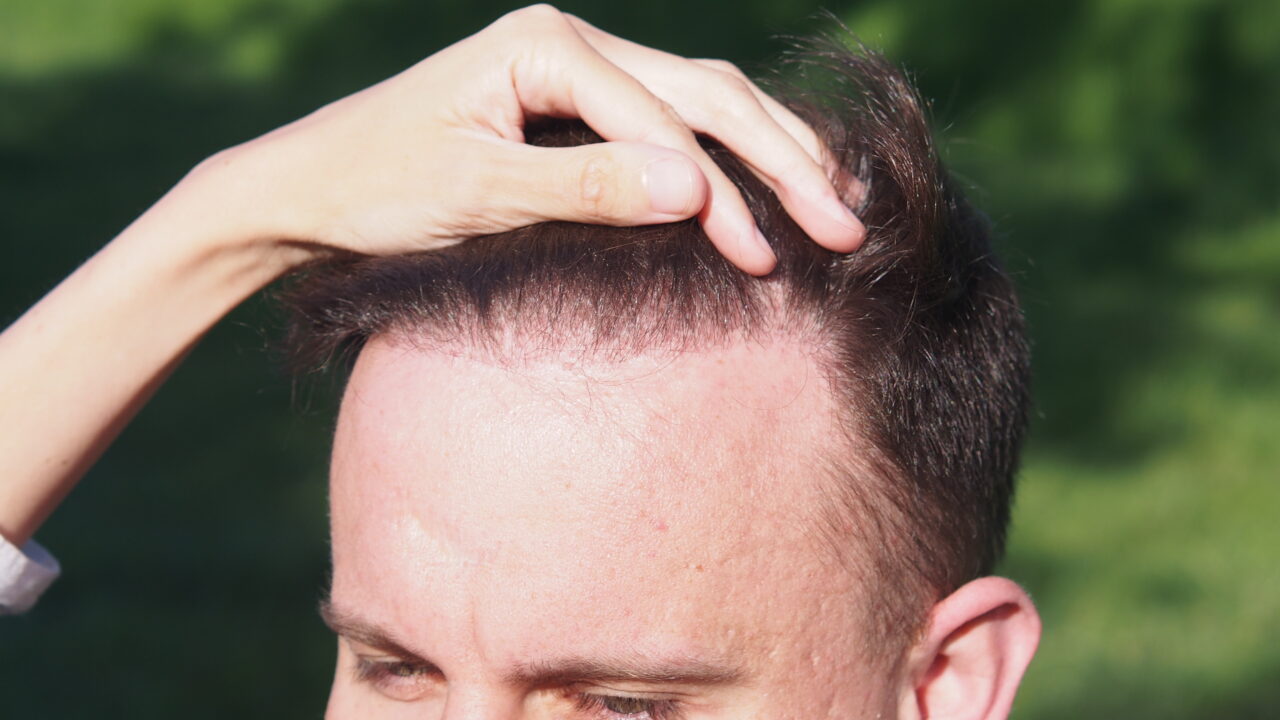 Odsłonięte czoło, łysienie