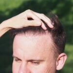 Odsłonięte czoło, łysienie