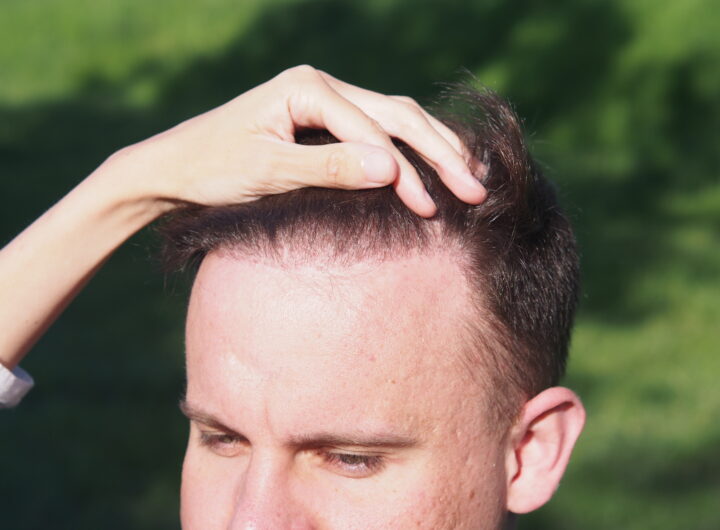 Odsłonięte czoło, łysienie